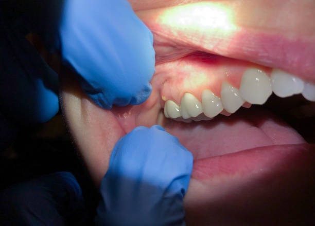 Best Emergency Care for Gum Disease in Fort Mckinley, OH