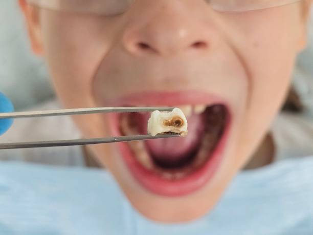 Best Broken or Chipped Tooth Repair in Fort Mckinley, OH